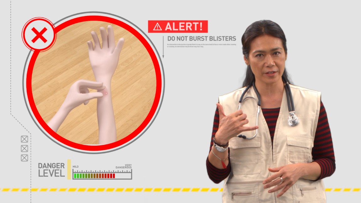 Screenshot of the first aid video on burns